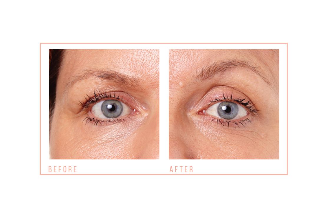 CACI Ultra Eye Revive (Classic) Claire Price Beauty Clinic, Clarins