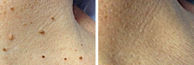 SKIN TAG REMOVAL