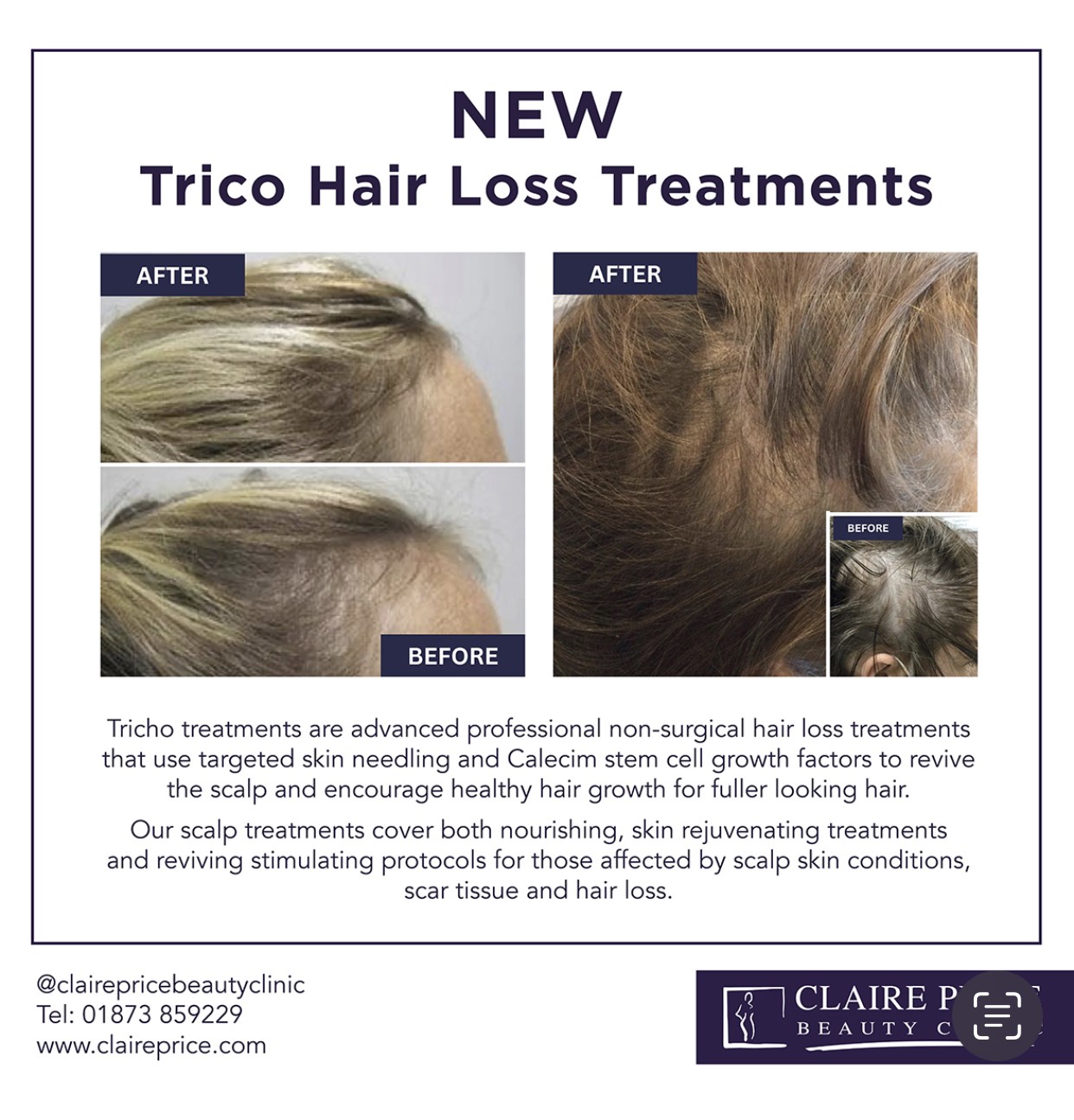 New Trico Hair Loss Treatment