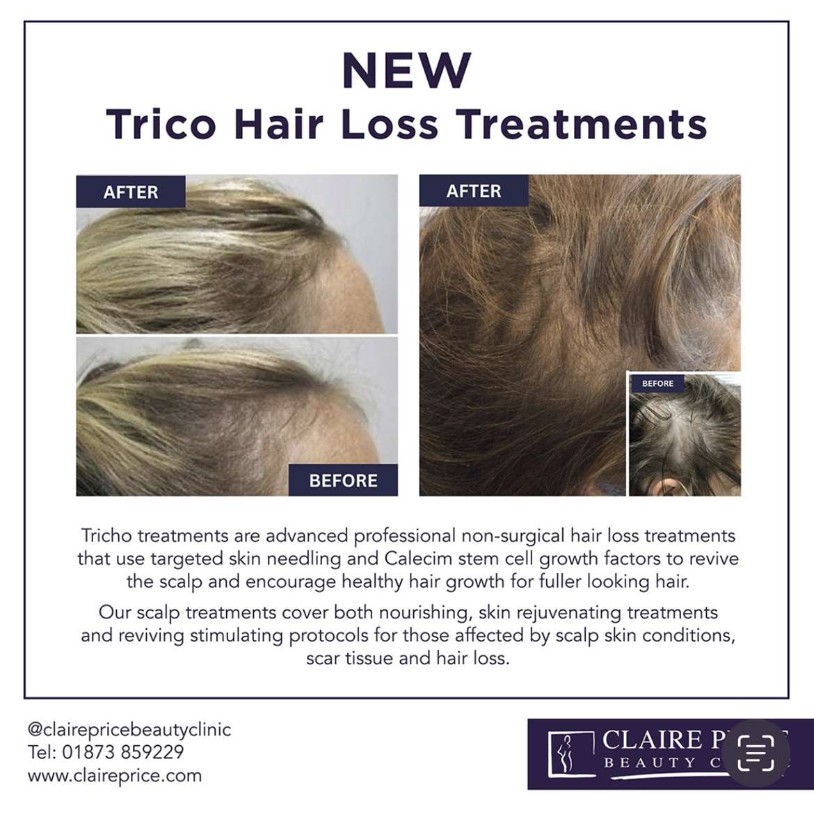 New Trico Hair Loss Treatment